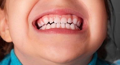 Her 4 çocuktan 1’inde bruksizm görülebiliyor